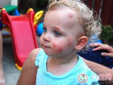 夏天寶寶招蚊子咬怎么辦 蚊子為什么總喜歡咬寶寶 夏天寶寶招蚊子咬怎么辦 蚊子為什么總喜歡咬寶寶