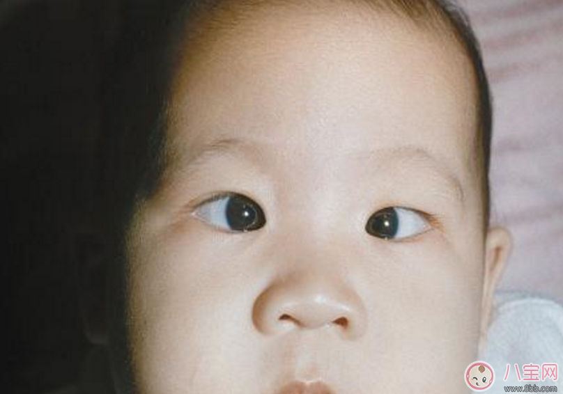 孩子內(nèi)斜視怎么辦 怎么糾正孩子內(nèi)斜視