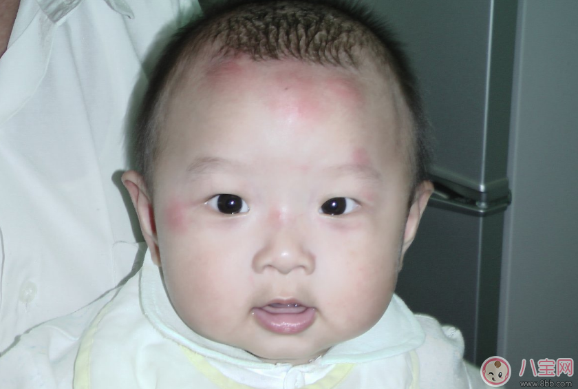 孩子用花露水竟然出現(xiàn)狀況 驅(qū)蚊給孩子用什么好 孩子用花露水竟然出現(xiàn)狀況 驅(qū)蚊給孩子用什么好