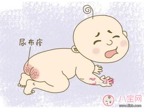 嬰兒長(zhǎng)尿布疹怎么辦 尿布疹是怎么引起的 嬰兒長(zhǎng)尿布疹怎么辦 尿布疹是怎么引起的
