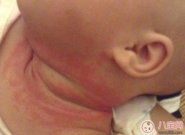夏天寶寶脖子被淹和起痱子的區(qū)別在哪里(圖文) 夏天寶寶脖子被淹和起痱子的區(qū)別在哪里(圖文)