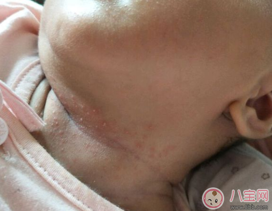 夏天寶寶脖子被淹和起痱子的區(qū)別在哪里(圖文) 夏天寶寶脖子被淹和起痱子的區(qū)別在哪里(圖文)