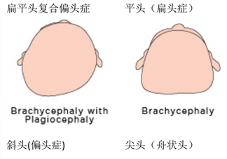預(yù)防寶寶平頭扁頭 嬰兒如何塑造好頭型 定型枕頭沒(méi)用