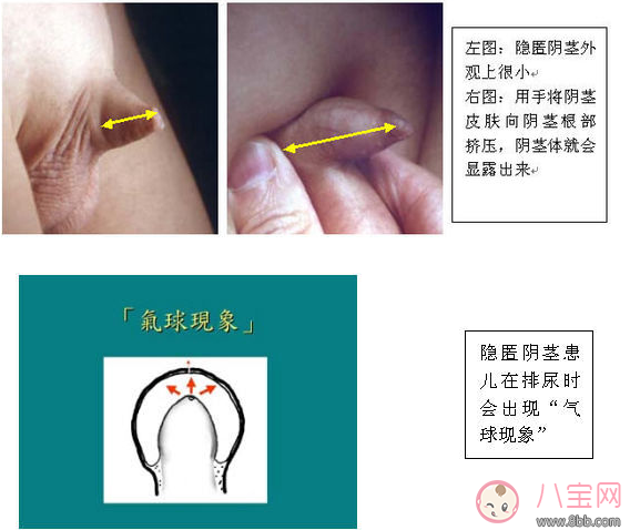 嬰兒陰莖短小 男寶寶下面很小是正常的嗎 嬰兒陰莖短小 男寶寶下面很小是正常的嗎