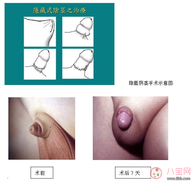 嬰兒陰莖短小 男寶寶下面很小是正常的嗎 嬰兒陰莖短小 男寶寶下面很小是正常的嗎