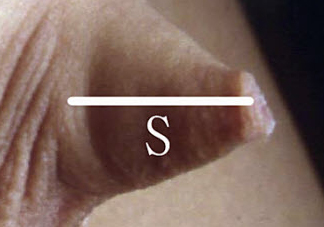 嬰兒陰莖短小 男寶寶下面很小是正常的嗎