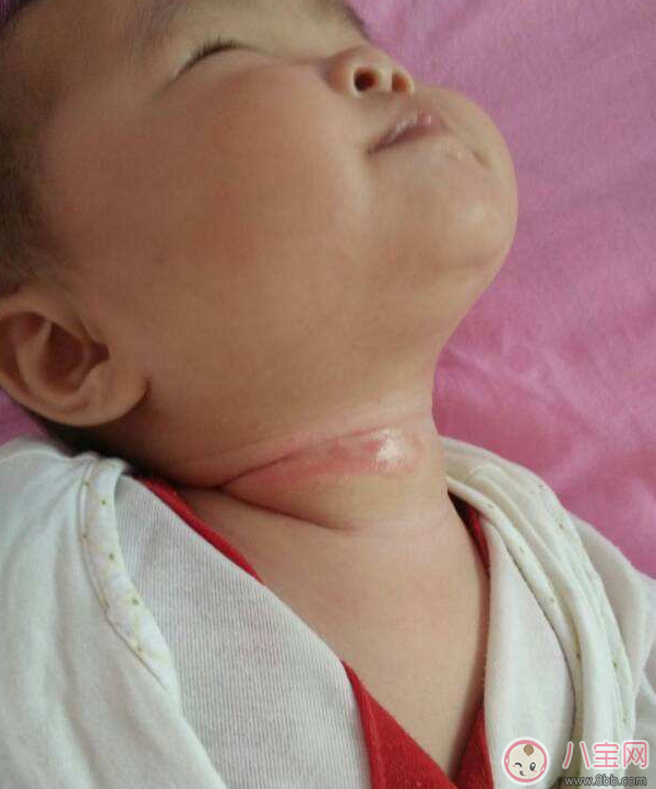 寶寶出汗脖子淹了怎么辦 嬰兒脖子淹了馬上好的土方法