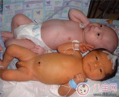 小兒黃疸嚴(yán)重嗎 黃疸怎么治 小兒黃疸嚴(yán)重嗎 黃疸怎么治