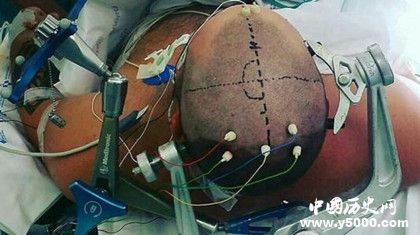 古代人有開顱手術(shù)嗎 古代人治療腦科疾病的方法 古代人有開顱手術(shù)嗎 古代人治療腦科疾病的方法