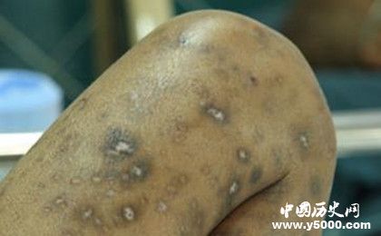 艾滋病來(lái)源之謎：艾滋病病毒是怎么衍生出來(lái)的