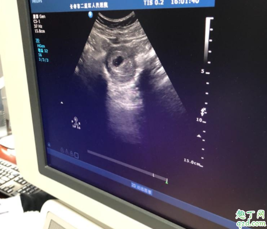胎芽是卵黃囊發(fā)育的嗎 有卵黃囊沒(méi)胎芽胎心多長(zhǎng)時(shí)間可以判定胎停2