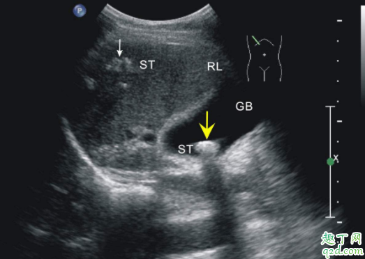 孕36周胎兒顯示頭偏小怎么辦 羊水少了吃什么可以補(bǔ)1