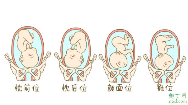 懷孕七個(gè)月寶寶臀位怎么糾正 單胎臀位不能順產(chǎn)嗎3