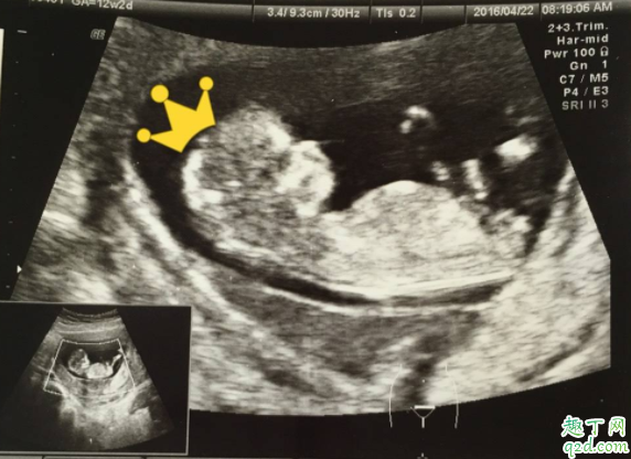 女性有甲減可以要小孩嗎 孕期甲減可以吃藥嗎4