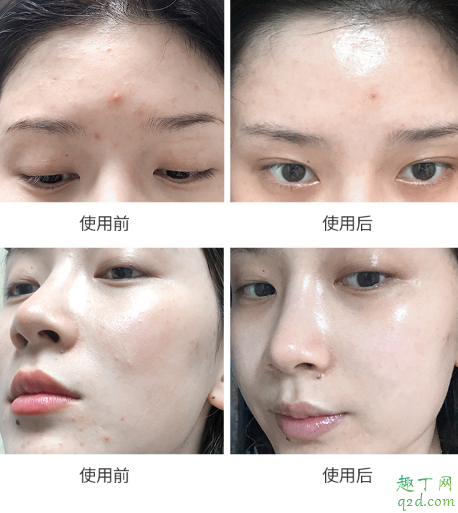 科娜藍面霜爆痘真的可以修復好嗎 科娜藍面霜孕婦能用嗎2