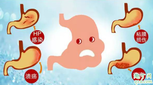 胃癌是不是必須開刀 胃癌癥會不會傳染2