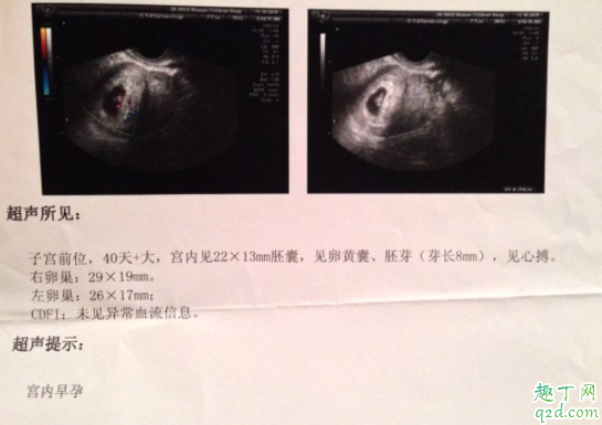 有卵黃囊就一定會有胎心胎芽嗎 卵黃囊什么時候能看到3