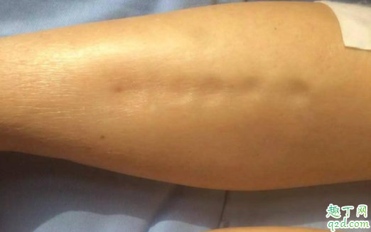 為什么有的孕婦會水腫 懷孕水腫有影響嗎3