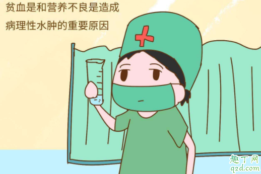孕期水腫正常的會腫到什么程度 孕期生理性水腫怎么緩解4