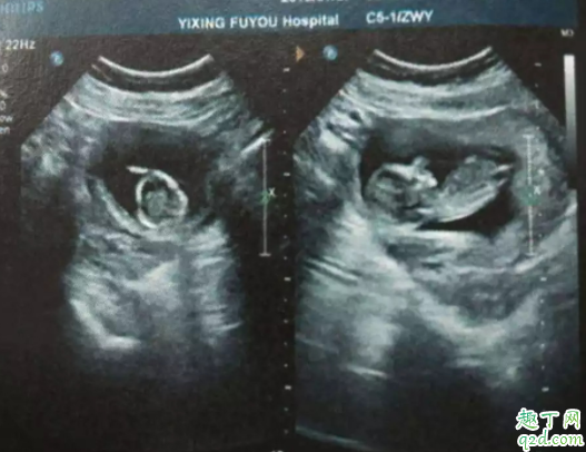 先兆流產(chǎn)出血幾天能好 孕酮低就是先兆流產(chǎn)嗎3