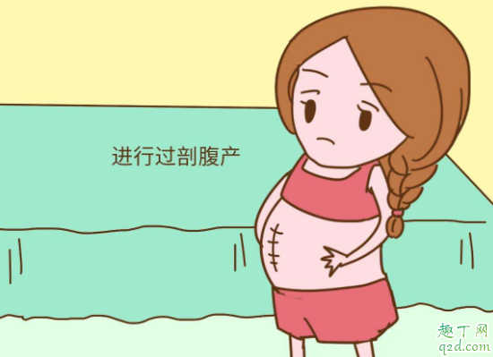 剖宮產橫剖豎剖哪個好 第二次剖腹產是在原傷口上剖嗎2