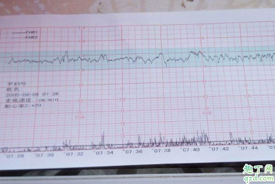 懷孕后沒有看到胎心胎芽怎么回事 懷孕多長時間用胎心監(jiān)護(hù)器3